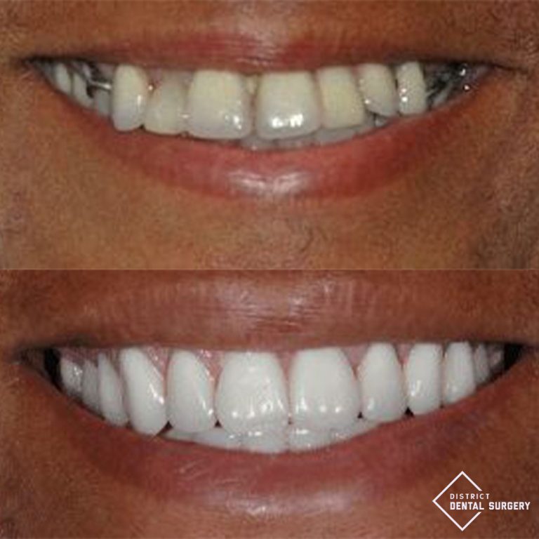 dentalimplants_1