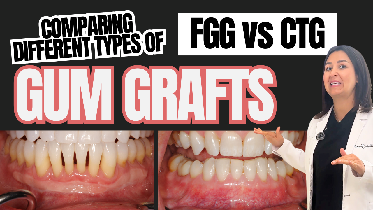 FGG vs CTG: Different Types of Gum Grafts