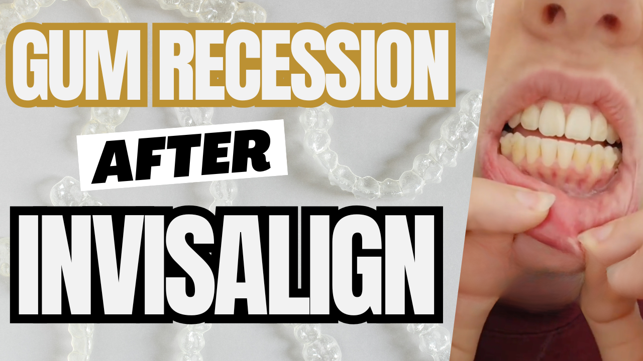 Gum Recession After Invisalign? SFOT Fixes That! - District Dental Surgery