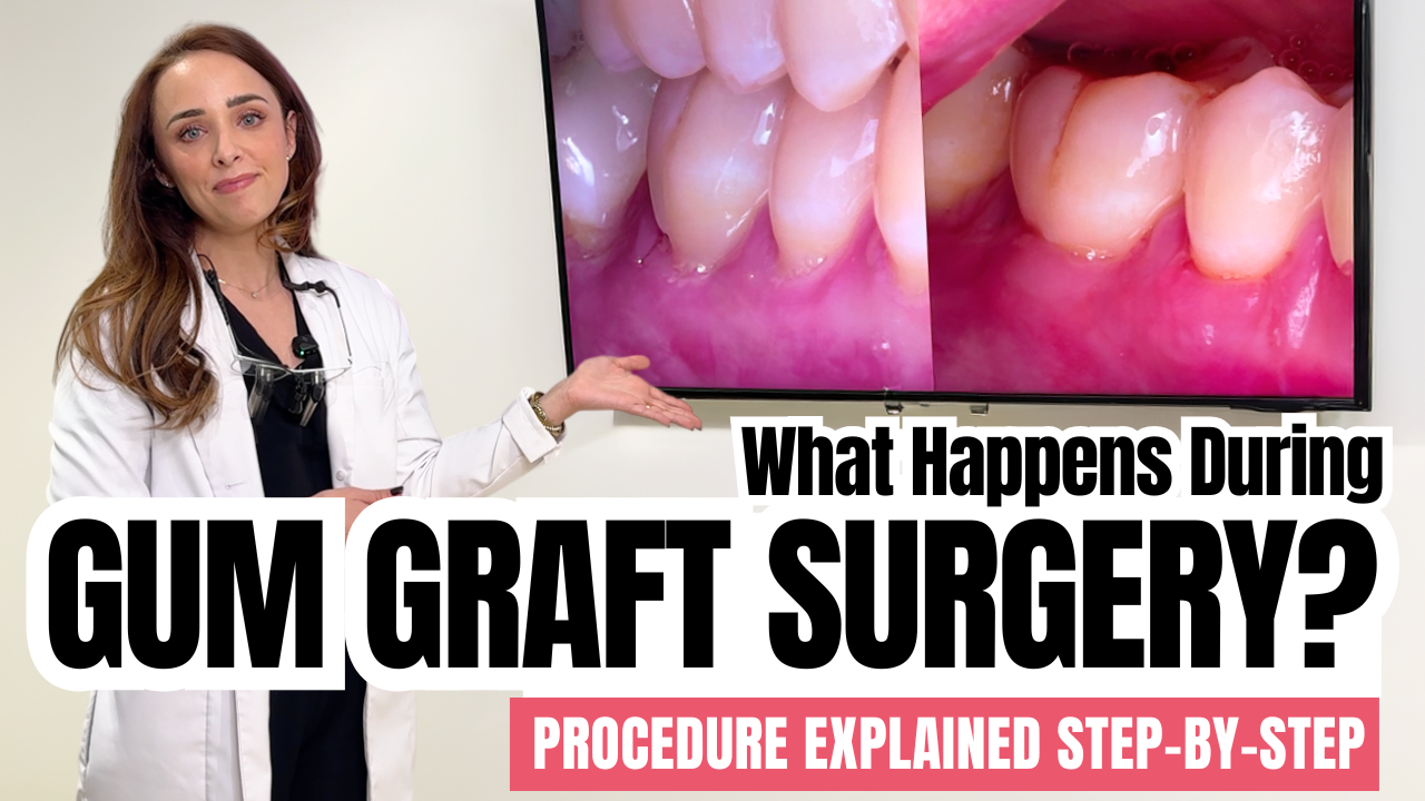 What Happens During Gum Graft Surgery? Gum Graft Explained Step-by-Step + Recovery Timeline