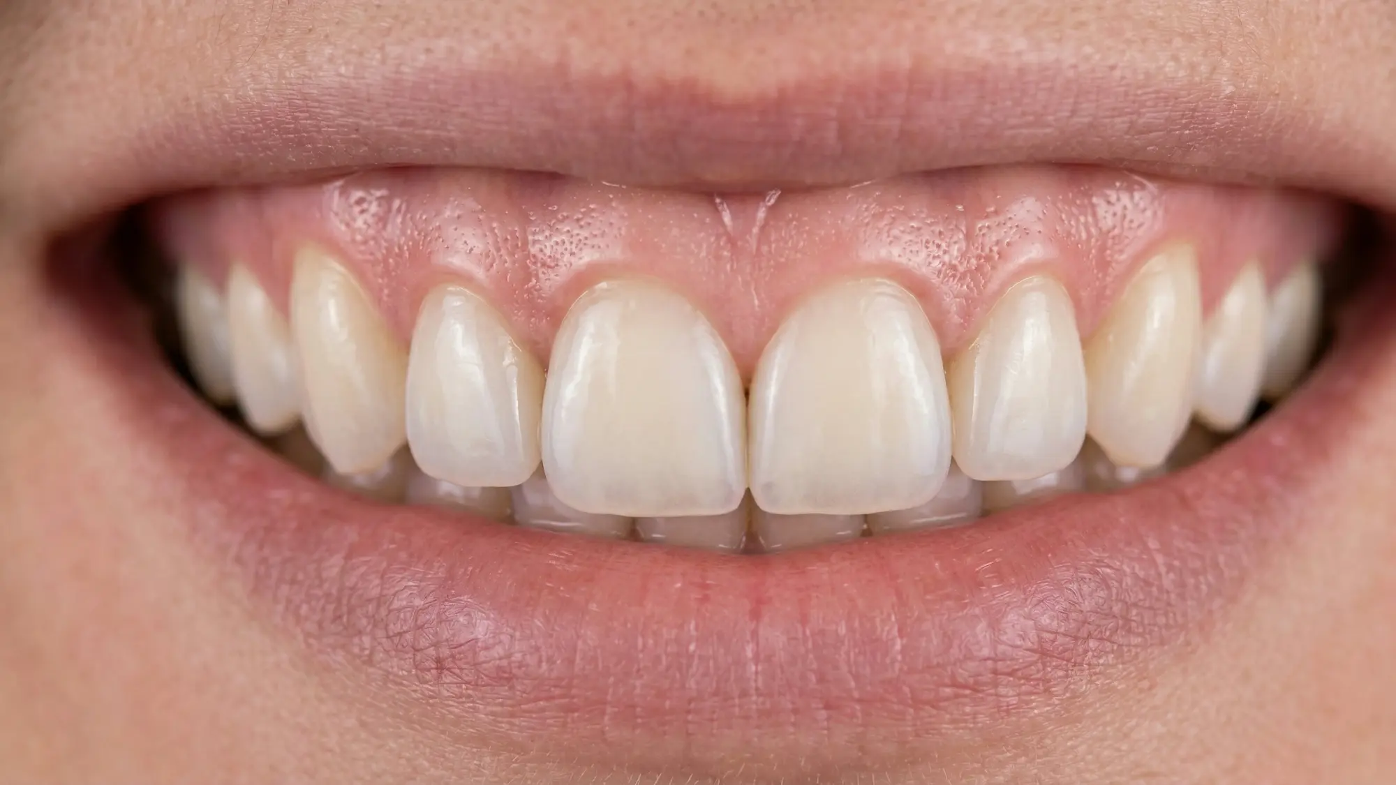 How Can I Fix a Gummy Smile Permanently?